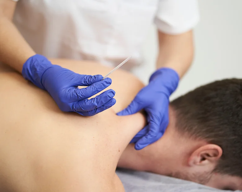 dry needling koekelberge ab therapy